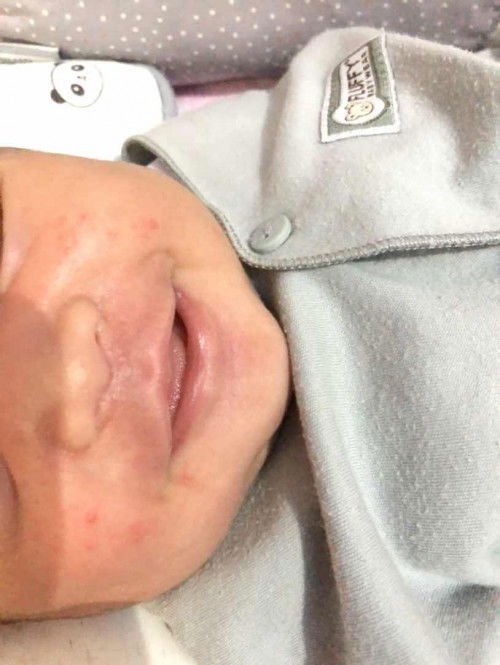 Merah pada muka bayi