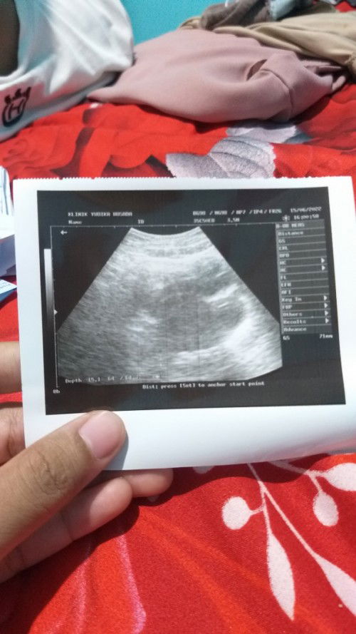 Usg pertama umur 5w masih penebalan dinding rahim ini usg ke 2 masih belum kelihatan jga