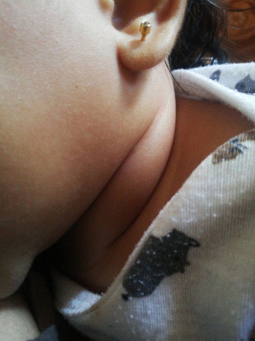 Bengkat dileher bayi 6 bulan kalo disentuh agak keras