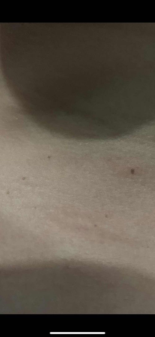 Muncul bintik2 hitam seperti kutil dileher