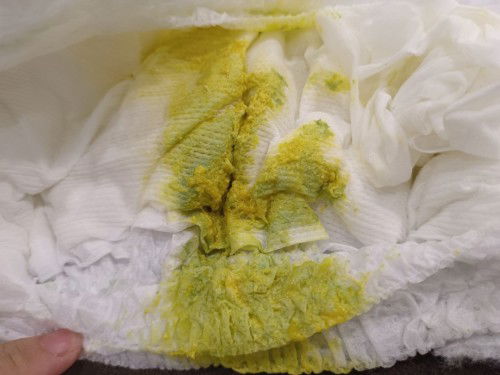 เด็กทารกอุจจาระ