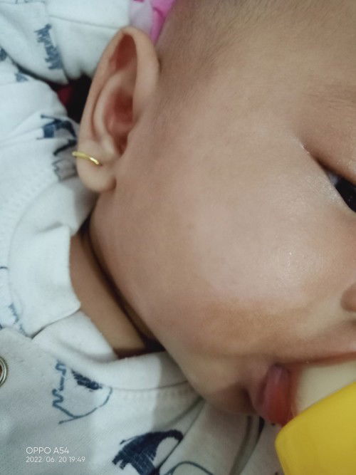 Muka bayi bercak putih apakah bisaa hilang bun??????
