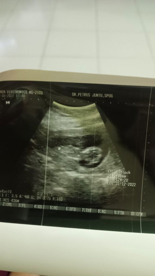 Bantu aku dong bun yg bisa baca hasil USG