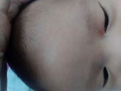 Dry skin in 1 month old baby