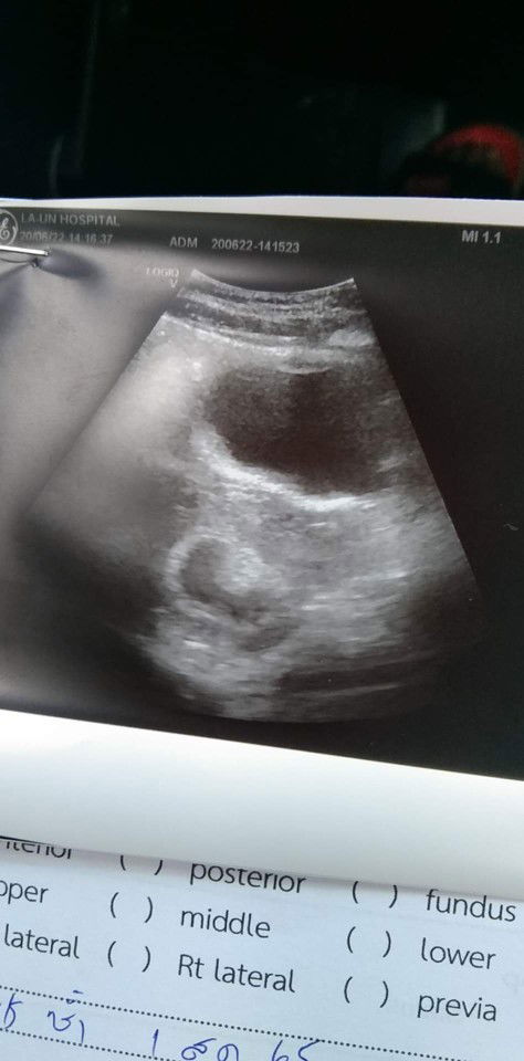 แม่ๆบ้านไหนอัตซาวด์แล้วเจอเจ้าจิ๊วบ้างค่ะ กี่วีคถึงจะเห็น แม่บ้านนี้6วีค ยังไม่เจอเลยค่ะแม่เครียดมาก