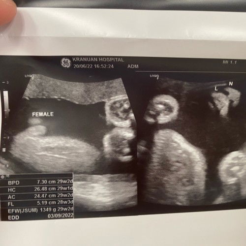 แม่ๆบ้านไหน 28+4wksบ้างคะ
น้องน้ำหนักเท่าไหร่กันแล้วคะ