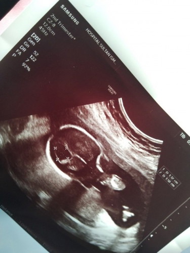 Kepala baby dalam kandungan bengkak..