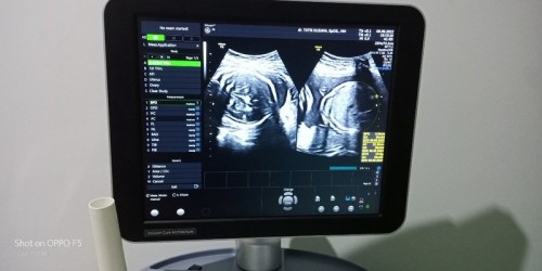 Apakah wajar Di usia kandungan 7 ke atas Bayi terlilit tali pusat?