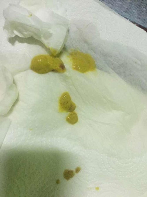 ขอสอบถามผู้รู้หน่อยค่ะ เมื่อคืนตอนประมานตี1 น้องถ่ายมามีมูกเลือดปน เกิดจากสาเหตุอะไรค่ะ