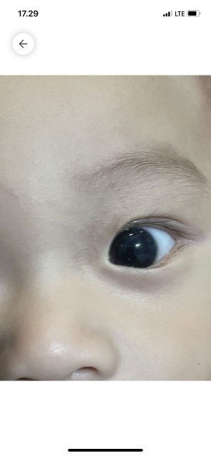 Flek hitam di kelopak mata bayi