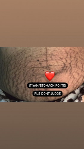 STRETCHMARKS (PLS DONT JUDGE)
