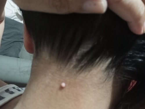 wart or mole?