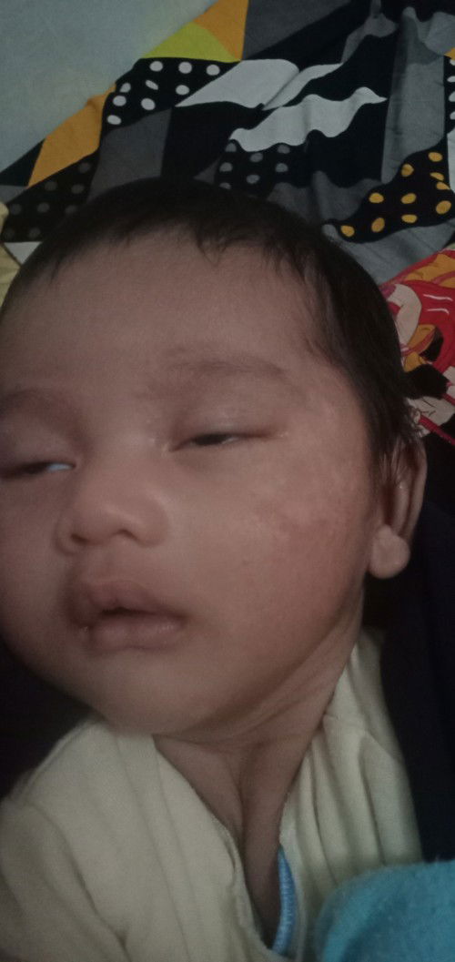 Ruam di wajah bayi