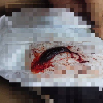 แบบนี้หมายถึงแท้งแล้วหรือเปล่าคะ