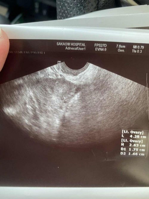 เหมือนจะท้องนอกมดลูก