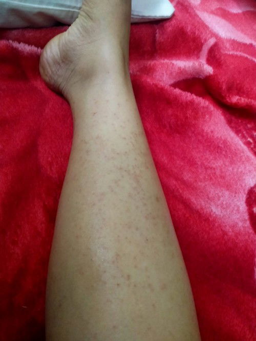 Gatal gatal seluruh badan