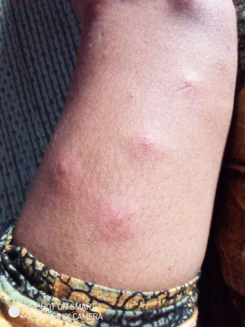 Bun Adakah Yg Kaya Saya Karna Ngga Haid² Jadi Gatal²