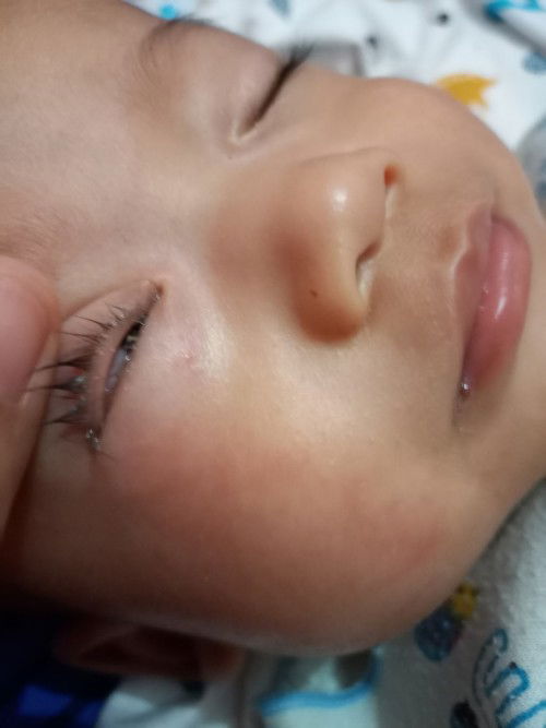 Mata berair dan belekan