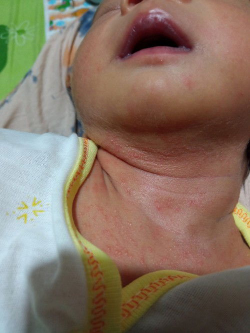 Bintik dileher dan dada