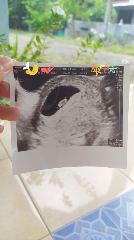 USG Pertama di Kehamilan Pertama Usia 8w