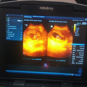 USG
Bun mau tanya, ini kandungan saya 13 Minggu . Tp kok blm kelihatan jelas ya Bun? Ada yang sama?.