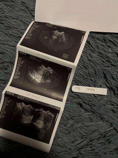 NO GESTATIONAL & NO EMBRYO