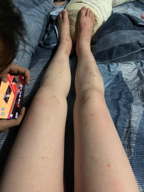 paha kaki bintik gatal saat hamil