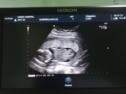 Breech baby, 15weeks