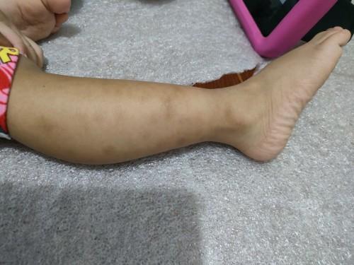 Dark spot to legs