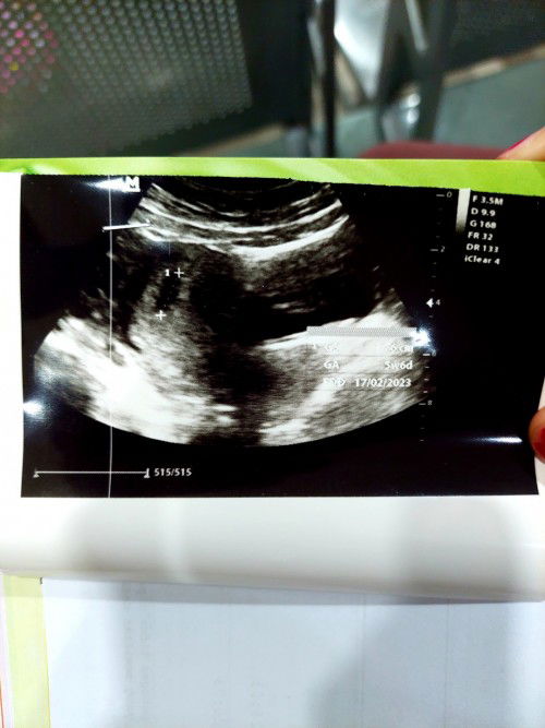 hasil usg 5 minggu 6 hari