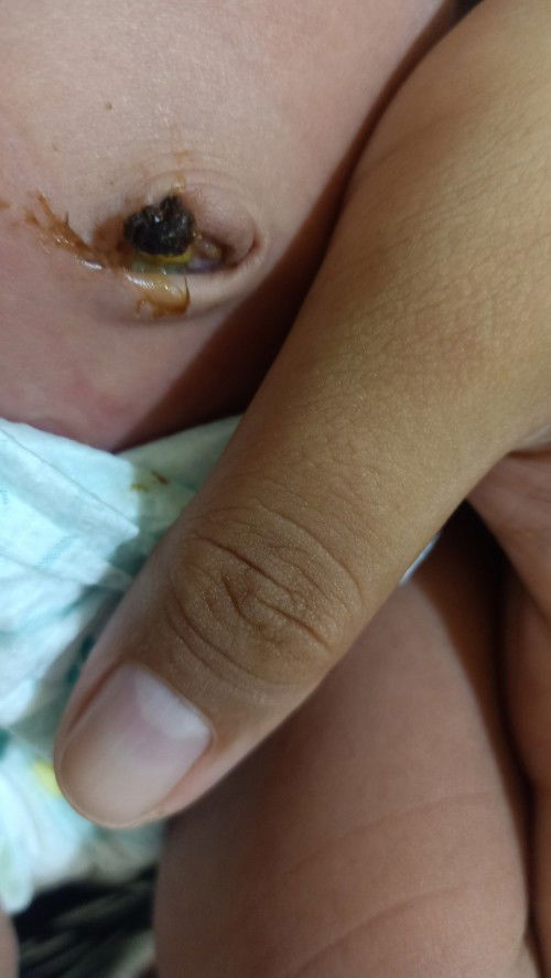 Normal or Not?  (Cord Stump)