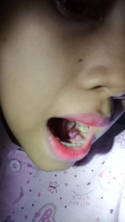 Tumbuh daging digusi