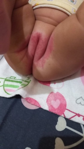 Obat ruam apa iya bunda yg bagus