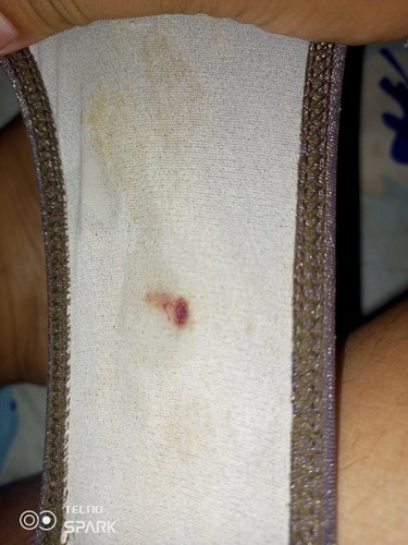 Bleeding in 14 weeks