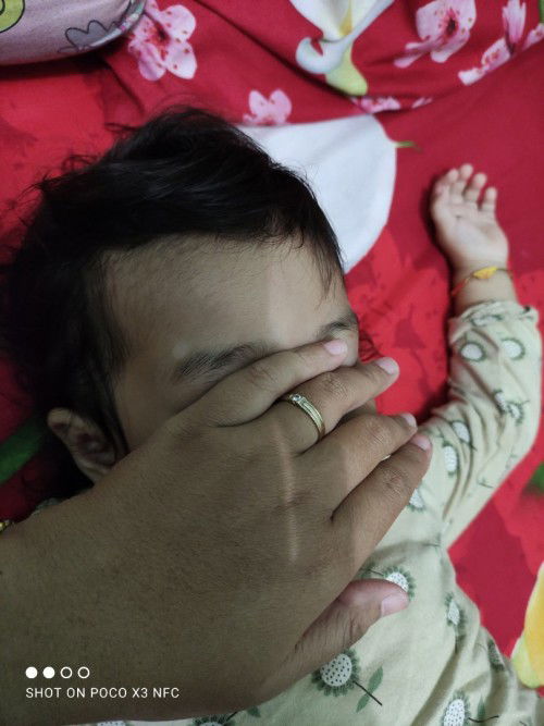 bund, mau tanya dong adakah anak nya yg mengalami putih di wajah seperti anak saya, share dong bund?