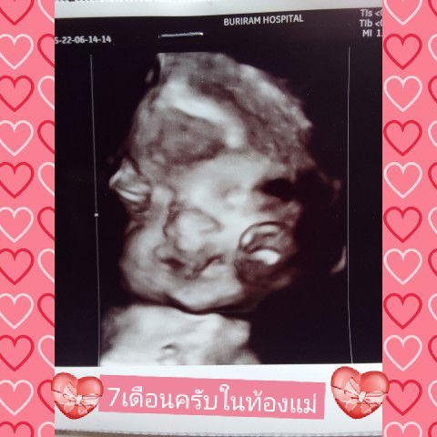 ตอนผม7เดือน