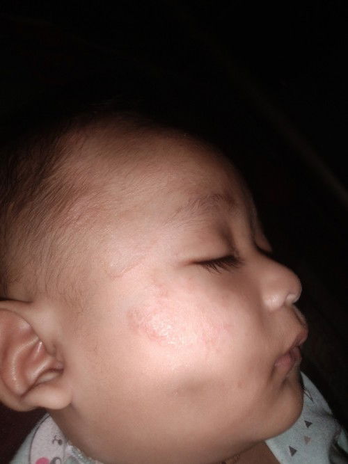 Merah merah pada pipi