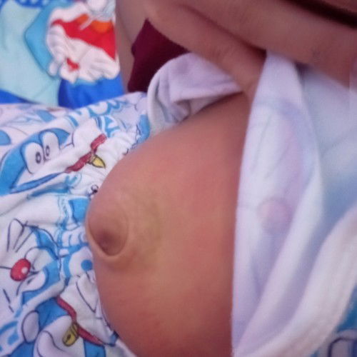 ลูกคนไหนสะดือเป็นแบบนี้บ้างคะลูกเราเป็นแล้วหมอบอกให้ต้องผ่าตัดไม่งั้นเดี๋ยวจะเน่ากลัวมากเลยค่ะ