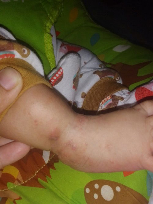 Ruam merah di kaki bayi