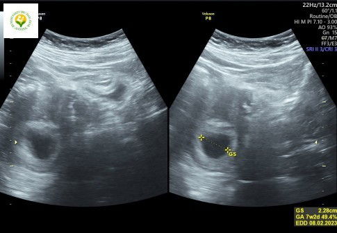 Usia Kantong & Bakal Janin berbeda, selisih beberapa hari apakah normal?