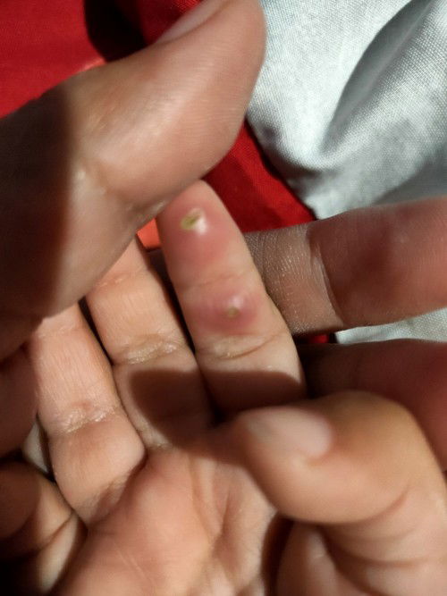 tangan anak bentol keras