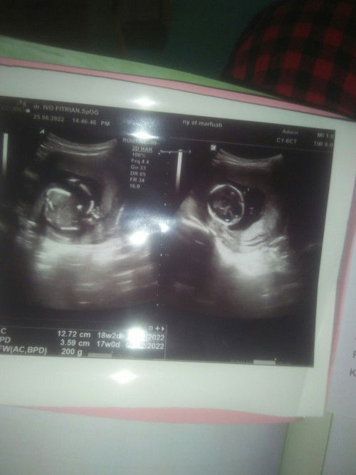 Adakah yang pernah alamin Flek di uk 17 minggu, disertai nyeri itu tanda2 apa ya bun??