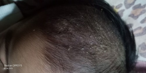 cradle cap