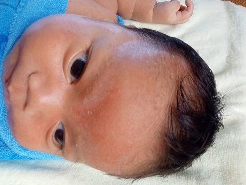 ลูกเกิด26วันที่หน้ามีไขขาวๆทำไงถึงให้หายคะ