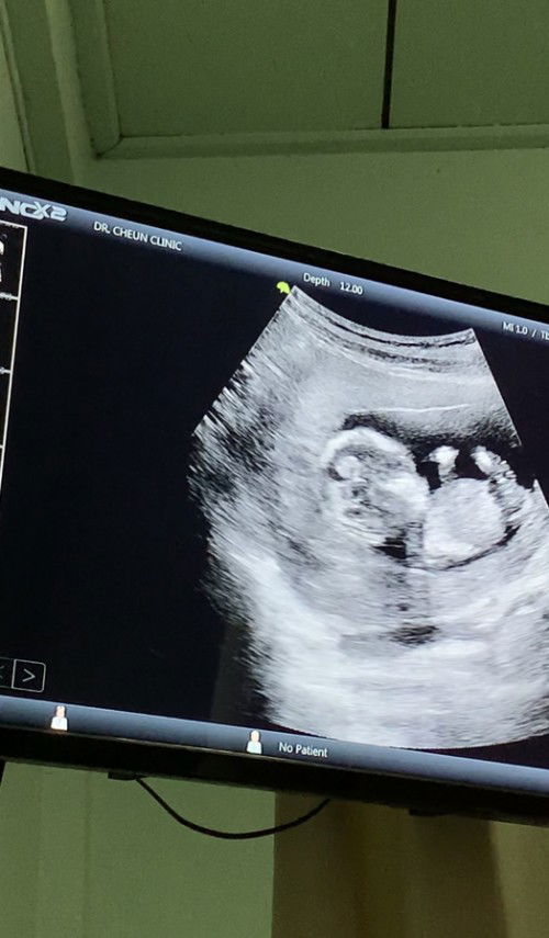 น้อง14วีค4วัน อัลตราซาวด์2มิติ น้องหัวโตแบบนี้ปกติไหมคะ กังวลมากค่ะแม่ๆท่านไหนพอทราบบ้างคะ ว่าแบบนี้น้องปกติไหม