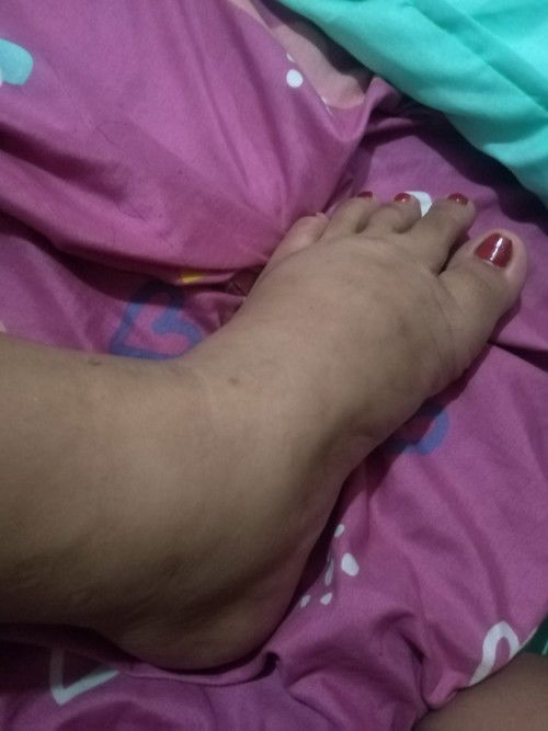 Pamamaga ng binti at paa