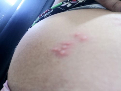 Masakit at makating butlig