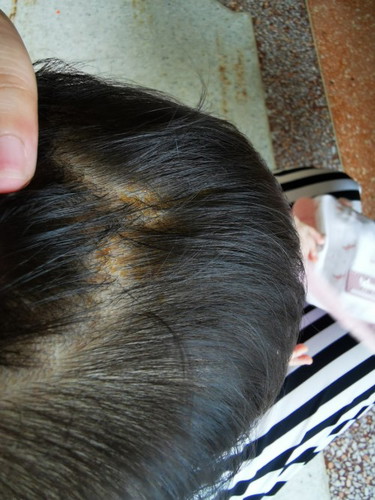 หนังศีรษะลูกเป็นเกล็ดเหลือง