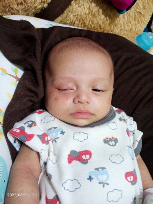 Ruam merah pada mata bayi