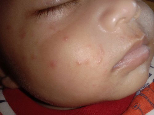 Bntik mrh dpipi itu knpa ya bund, sharing dong, ank sy umr 4bln.